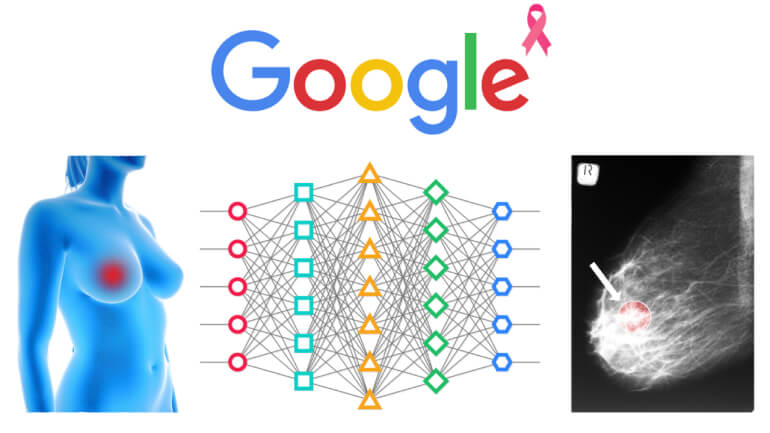 Google's AI System Bests Radiologists at Detecting Breast Cancer